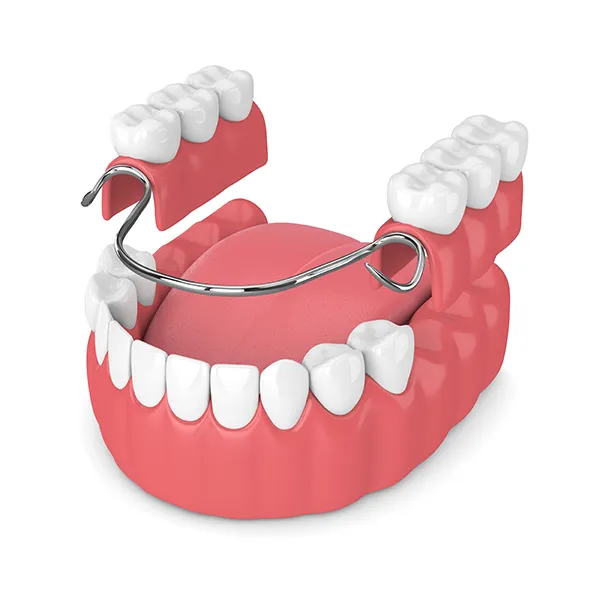 3D rendering of partial dentures being placed on a lower jaw with missing back teeth at Lone Pine Dental in Bend, OR 3D rendering of partial dentures being placed on a lower jaw with missing back teeth at Lone Pine Dental in Bend, OR